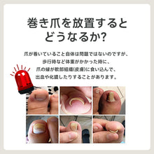 Load image into Gallery viewer, 巻き爪矯正チェーン
